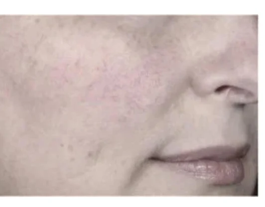 Помощь при куперозе, розацеи