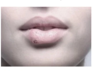 Избавление от ран, язв, герпеса