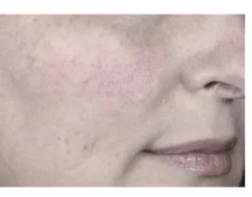 Помощь при куперозе, розацеи