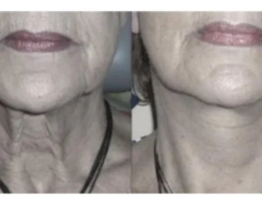 Устранение дряблости кожи