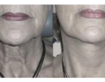 Устранение дряблости кожи