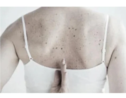 Удаление пигментации