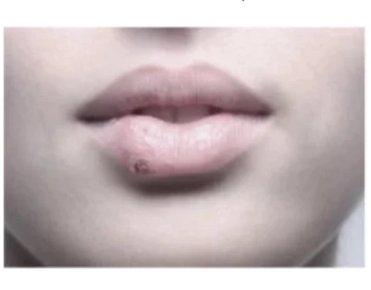 Избавление от ран, язв, герпеса